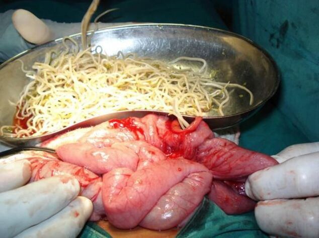 Paraziți intestinali